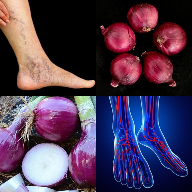 Żylaki zniknęły bez śladu! Koniec z bólem stóp – 100% naturalny środek z czerwoną cebulą!