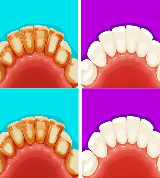8 skutecznych sposobów na usunięcie płytki nazębnej w pięć minut