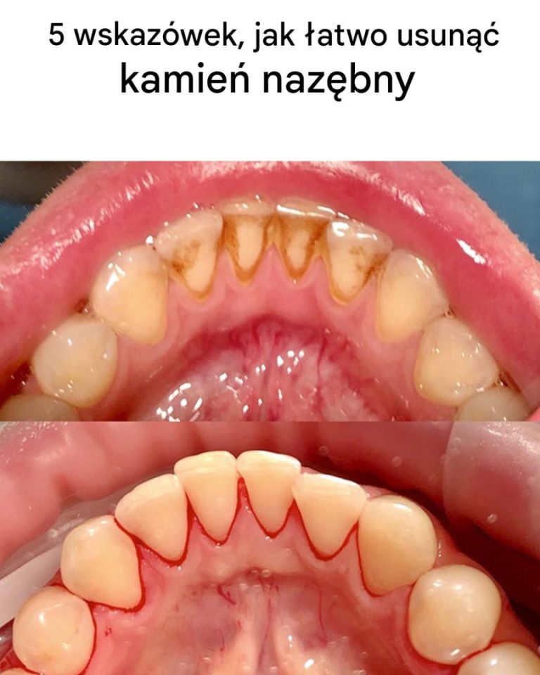 10 wskazówek, jak usunąć kamień nazębny