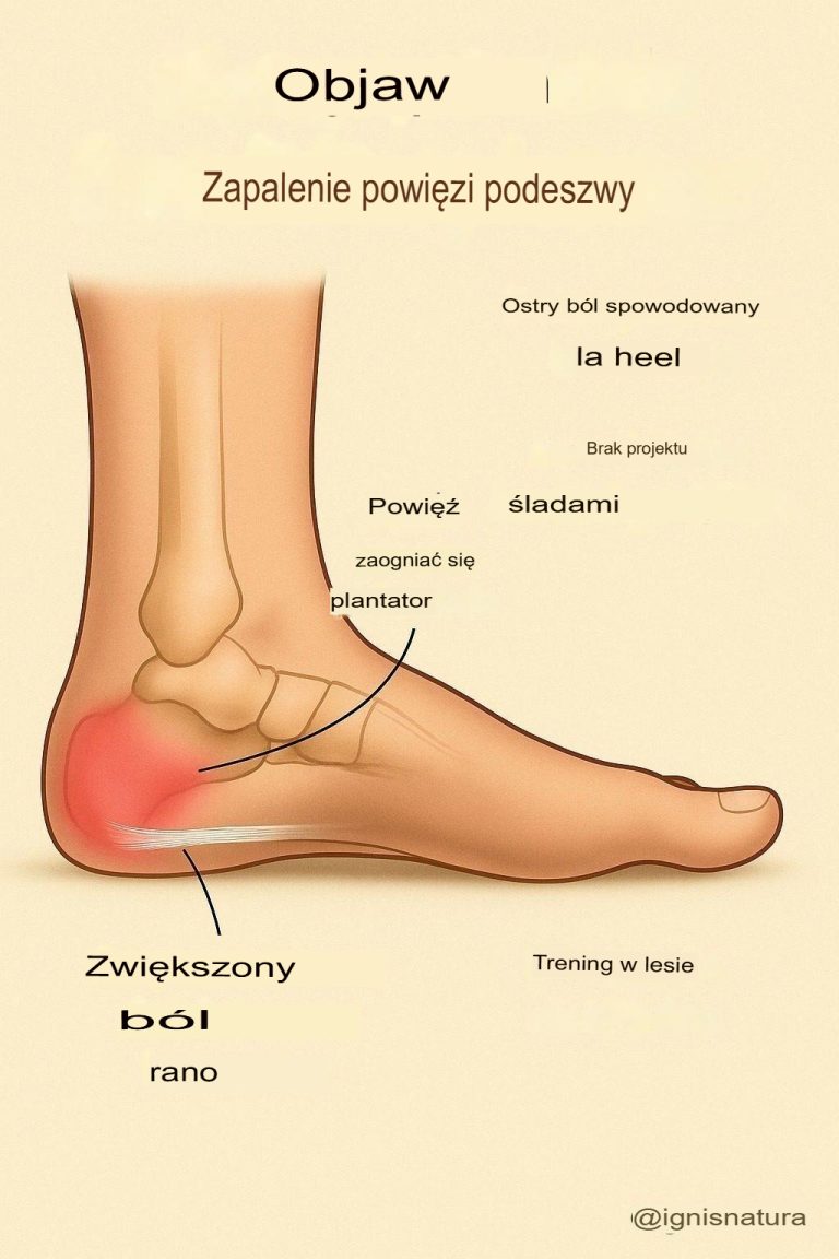 Zalecane ćwiczenia w leczeniu zapalenia powięzi podeszwowej