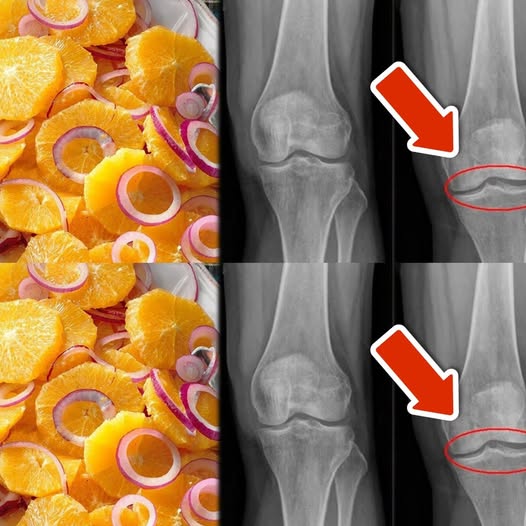 8 Super Easy Ways to Strengthen Your Knees, Cartilage, and Ligaments Using an Orange and Red Onion Mix