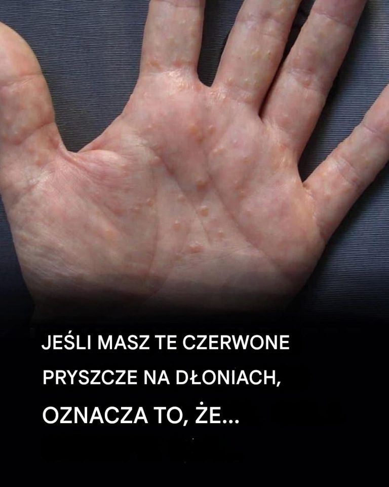 Jeśli widzisz te czerwone pryszcze na dłoniach, oto co to naprawdę oznacza
