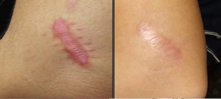 10 naturalnych środków na pozbycie się keloidów