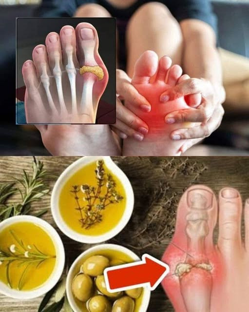 8 prostych sposobów na naturalne zmniejszenie nadmiaru kwasu moczowego