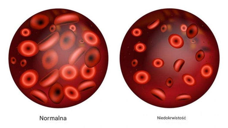 Czym jest anemia? Jakie pokarmy pomagają kontrolować tę chorobę?