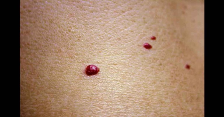 11 powodów, dla których na Twojej skórze pojawiają się czerwone plamy