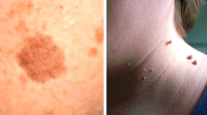 8 naturalnych sposobów na brodawki, narośla skórne i plamy starcze