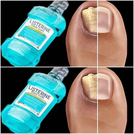 Ten prosty przepis pomoże Ci pozbyć się grzybicy paznokci na dobre! Z płynem do płukania ust