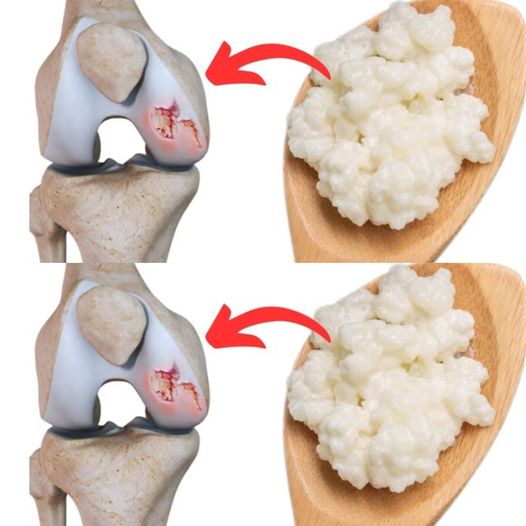 Pokarm dla odnowy chrząstki kolana: Korzyści z kefiru