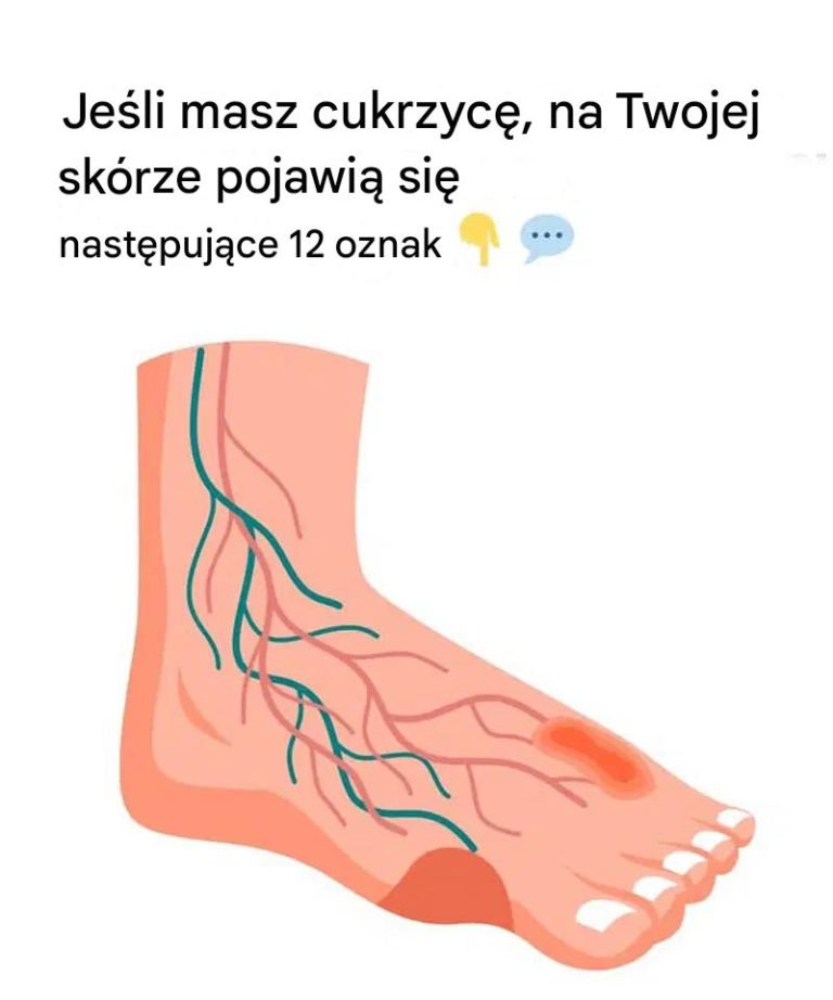 12 dziwnych problemów skórnych związanych z cukrzycą, o których musisz wiedzieć