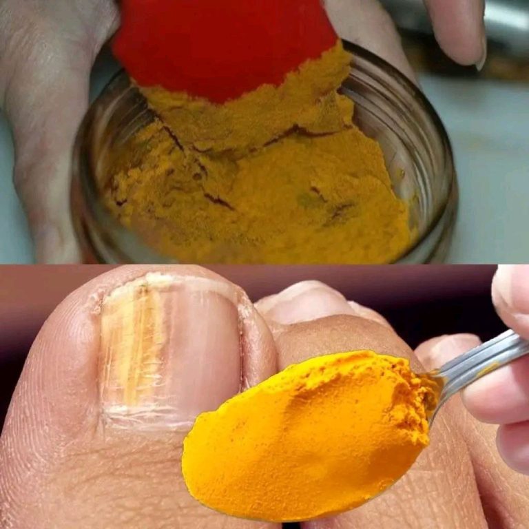 Eliminacja grzybicy paznokci: naturalna moc kurkumy