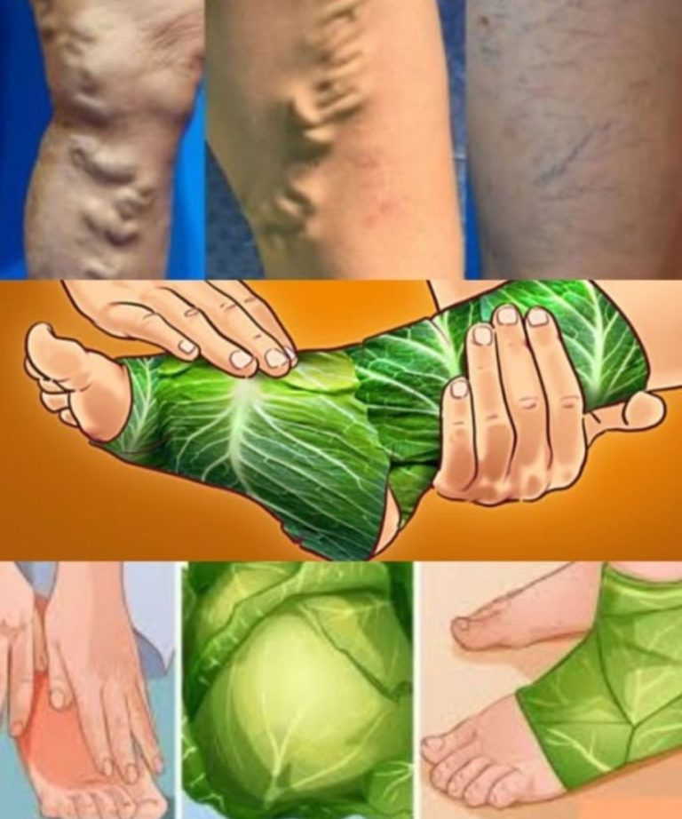 Niesamowite! Pozbądź się żylaków – po prostu połóż te liście i czekaj!