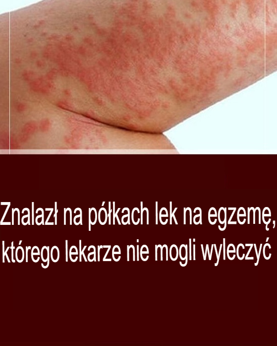 Matka znalazła lekarstwo na egzemę, którego lekarze nie potrafili wyleczyć na półce sklepowej