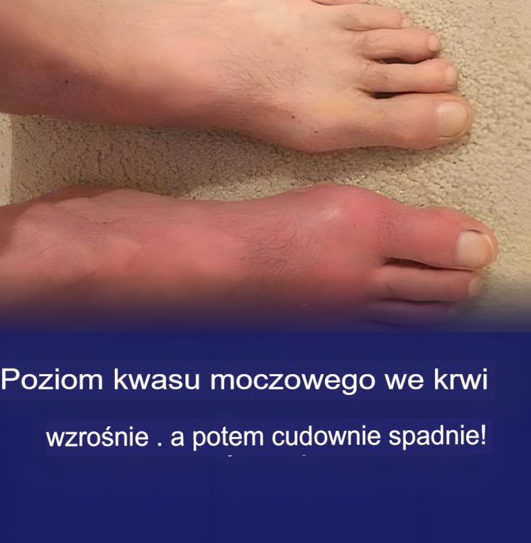 Jak naturalnie obniżyć poziom kwasu moczowego we krwi