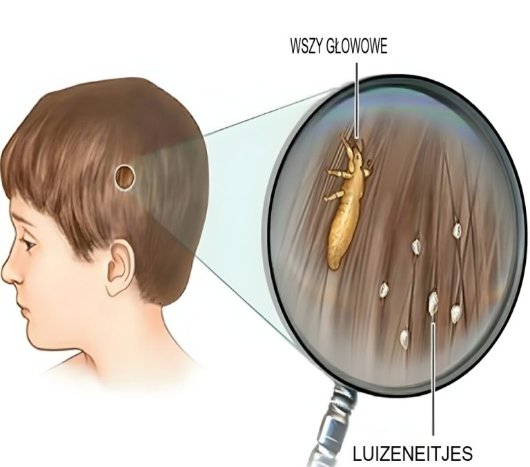 Wszy głowowe: Jak się ich pozbyć i zapobiec ich ponownemu pojawieniu