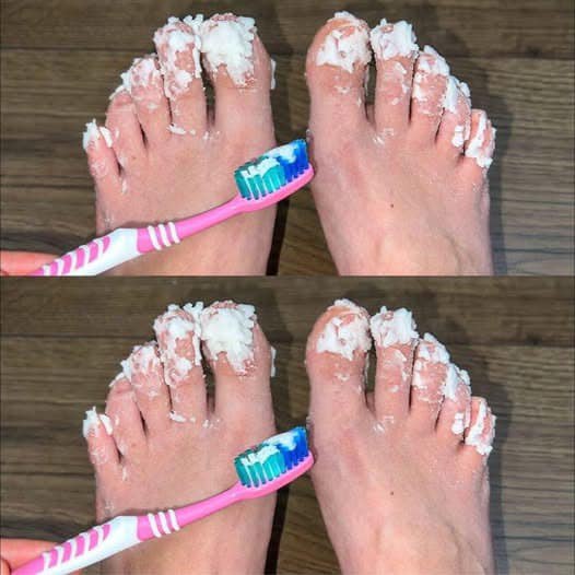 Naturalny Sposób na Grzybicę Paznokci: Skuteczny i Domowy Przepis na Zdrowe Stopy