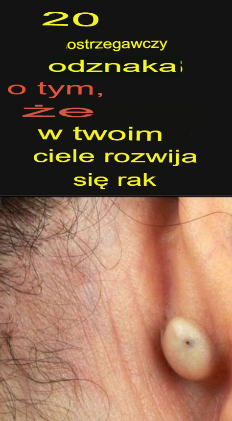 Jak usunąć zaskórniki