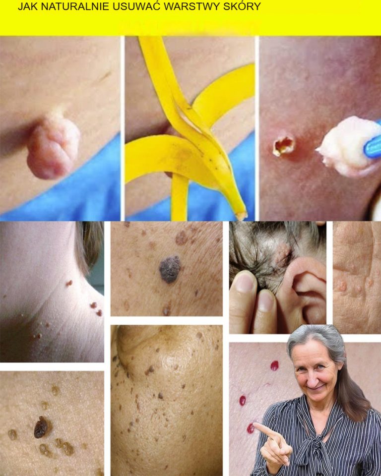 Jak usunąć narośla skórne w sposób naturalny?