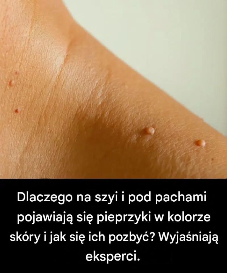 Dlaczego na szyi i pod pachami pojawiają się pieprzyki w kolorze skóry i jak się ich pozbyć? Wyjaśniają eksperci.