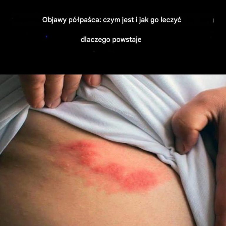 Czym jest półpasiec i jakie są objawy tej choroby?
