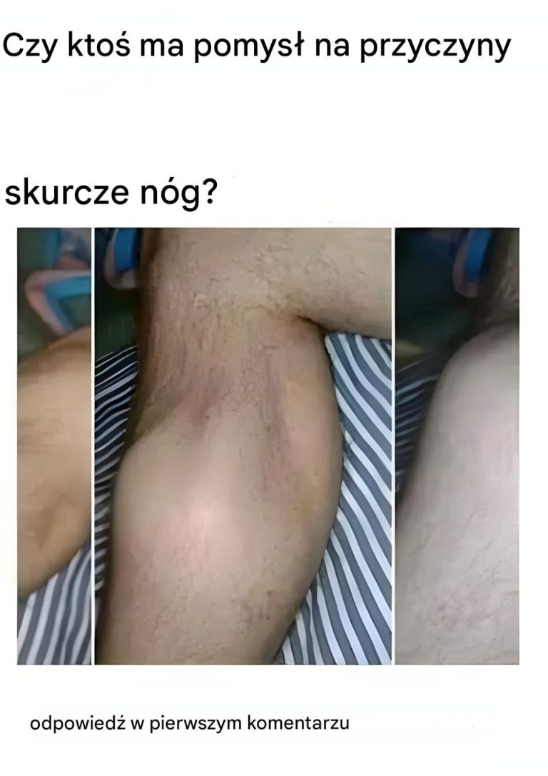 5 Sposobów na Złagodzenie Nocnych Skurczów Nóg i Jak Im Zapobiegać