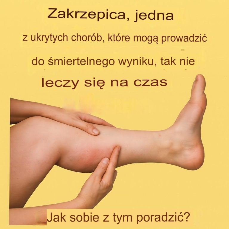 Czym jest zakrzepica i jakie są jej objawy?