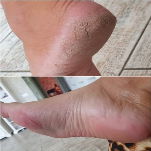 Obcasy jak u dziecka w 3 do 5 minut. Pokażę ci postępy i moje wyniki.