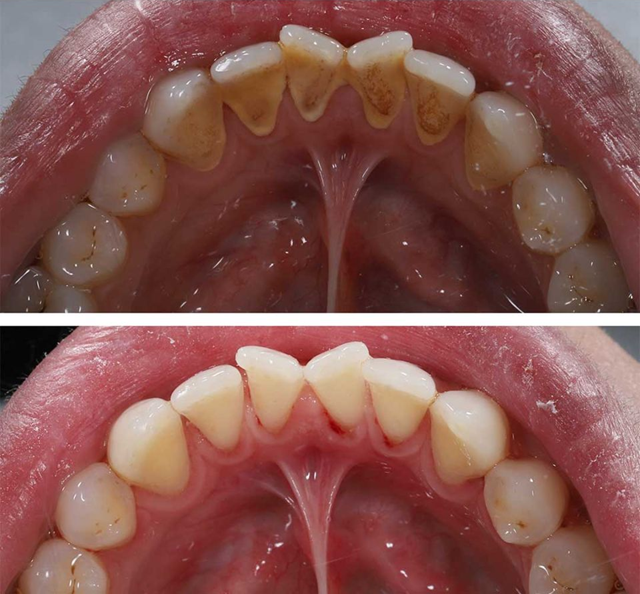 7 najlepszych sposobów na pozbycie się nieestetycznych plam z kamienia nazębnego przy prawie zerowym nakładzie pracy