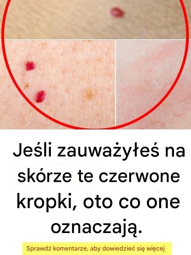 Jeśli zauważysz te czerwone kropki na swojej skórze, oto co one oznaczają