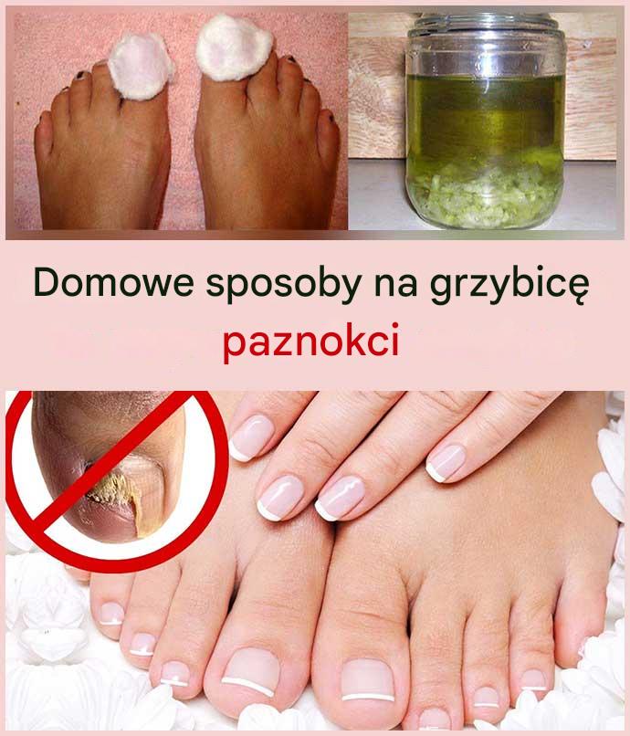 Domowe sposoby na grzybicę paznokci