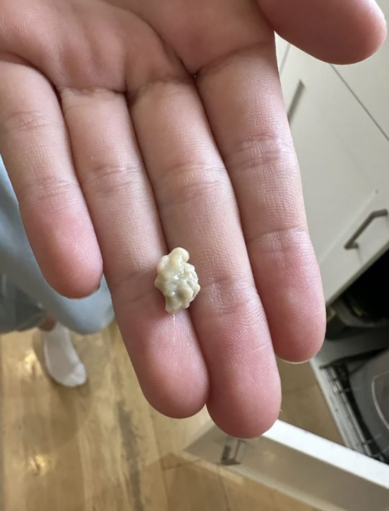 Wszystko, co musisz wiedzieć o kamieniach migdałkowych, czyli dziwnych, białych grudkach zagnieżdżonych w tylnej części gardła