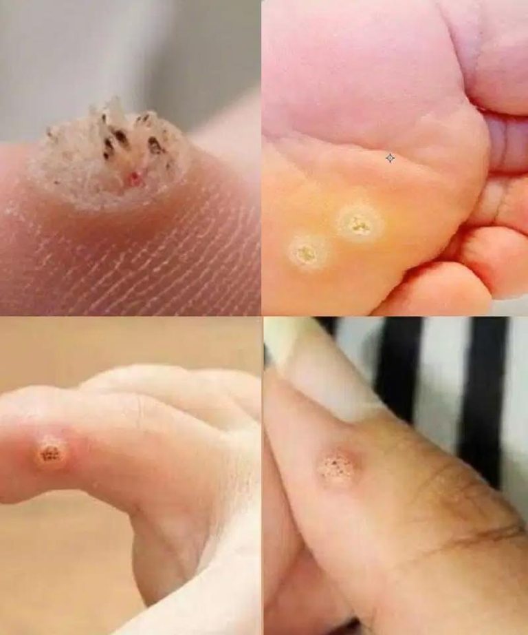 Bądź bardzo ostrożny: jeśli zauważysz ten narośl skórną, może to być poważne.