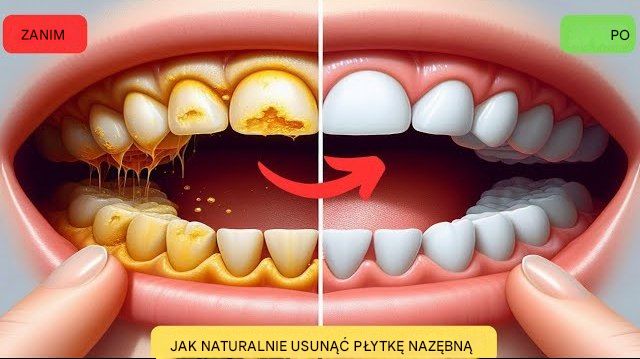 Usuń kamień nazębny i wybiel je dzięki temu prostemu przepisowi.