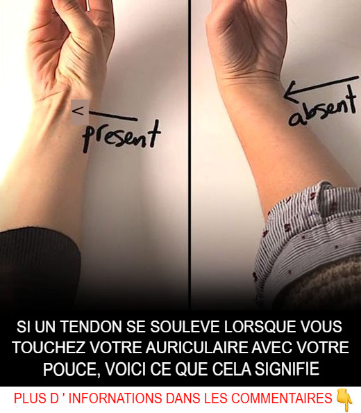 Jeśli ścięgno pęka, gdy dotykasz małego palca kciukiem, oto co to oznacza