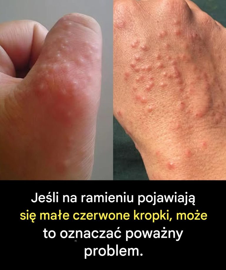 Masz te małe czerwone plamy na ramieniu? Oto, co one mają na myśli.