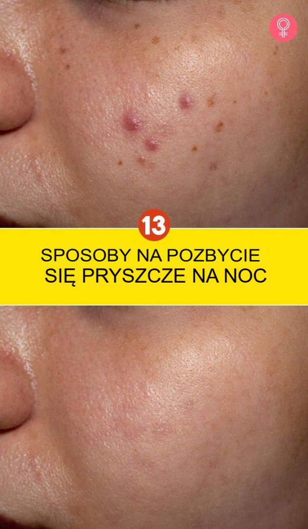 13 sposobów na pozbycie się pryszczy w ciągu nocy