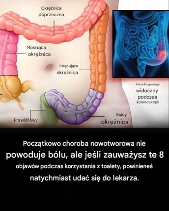 7 ostrzegawczych objawów raka jelita grubego, których nigdy nie należy ignorować