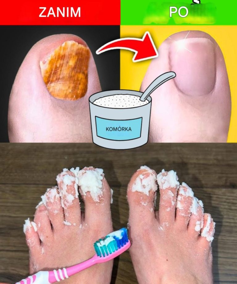 Jeśli masz grzybicę paznokci, wypróbuj ten naturalny środek