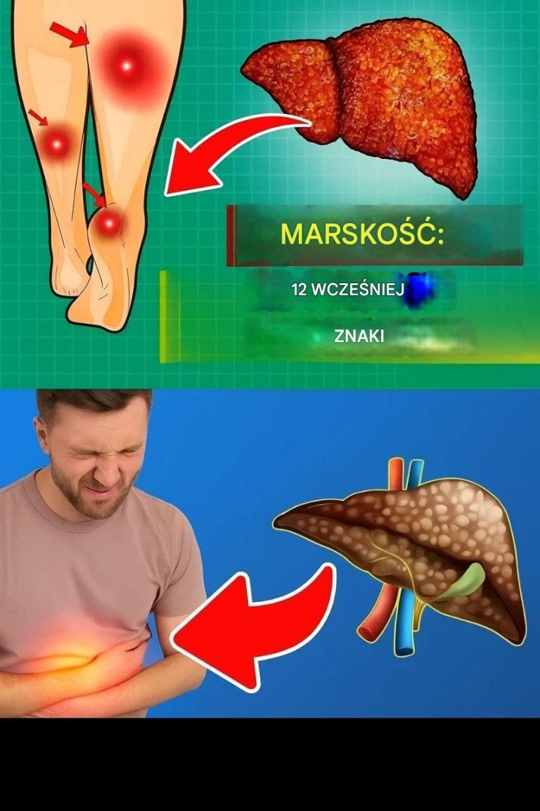 Twoja wątroba jest w NIEBEZPIECZEŃSTWIE 12 wczesnych objawów MARSKOŚCI WĄTROBY, których nie należy ignorować