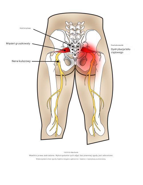 Pożegnaj ból nerwu kulszowego w mniej niż dziesięć minut dzięki tej wspaniałej naturalnej metodzie