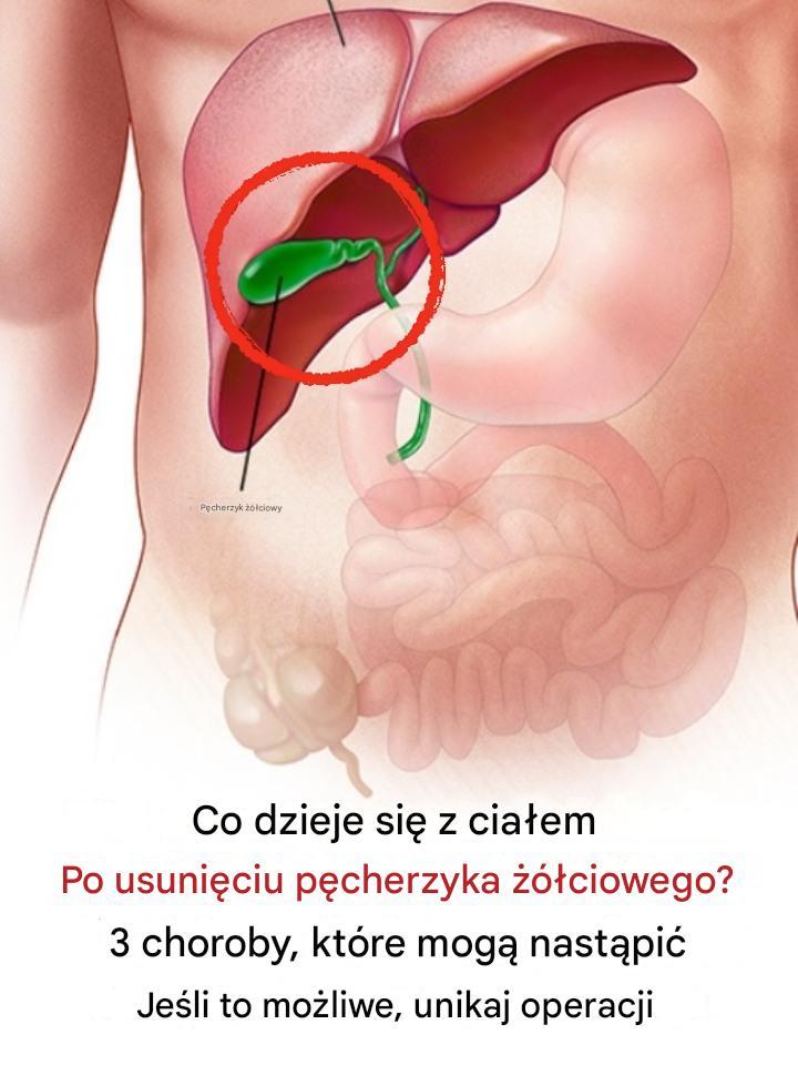 Co dzieje się z ciałem po usunięciu pęcherzyka żółciowego? 3 choroby, które mogą wystąpić – unikaj operacji, jeśli to możliwe