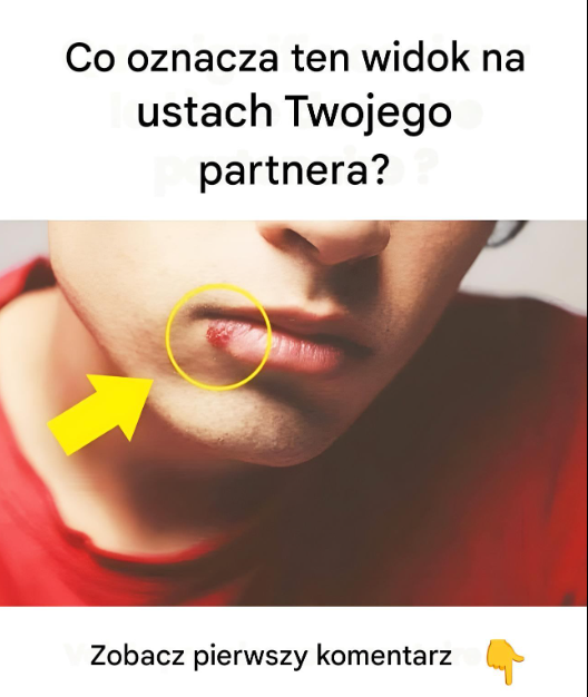 5 domowych sposobów na leczenie aft Artykuł znajduje się w pierwszym komentarzu