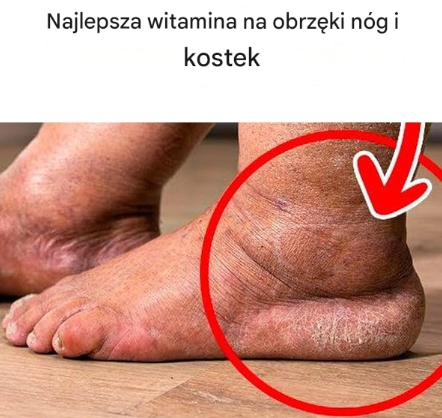 Najlepsza witamina na likwidację obrzęków nóg i kostek