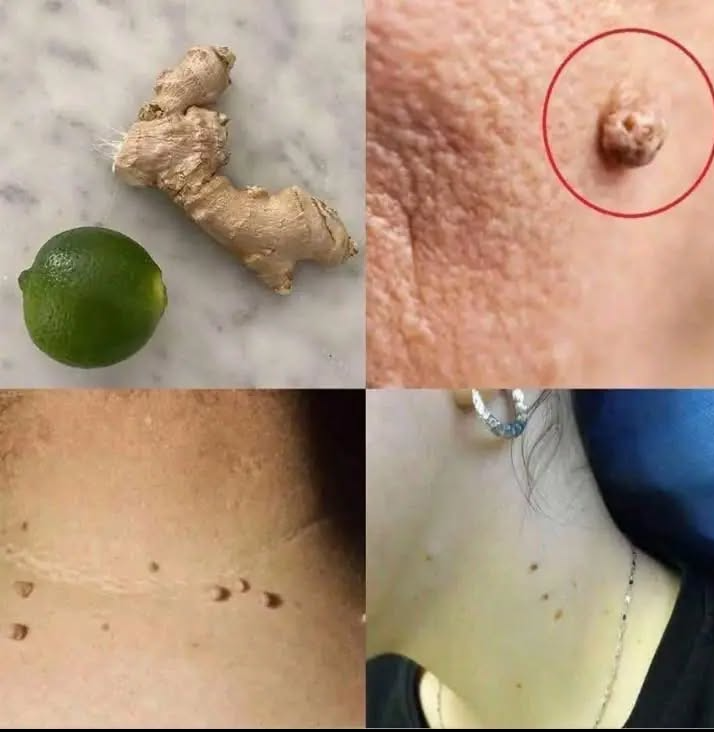 Jak pozbyć się pryszczy i brodawek?