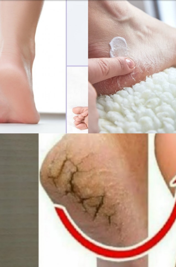 Ta naturalna sztuczka pomoże Ci uporać się z popękanymi piętami już od nocy!