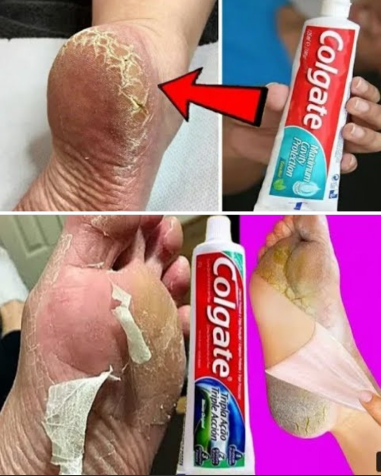 Odkryj zaskakujący trik Colgate na miękkie stopy