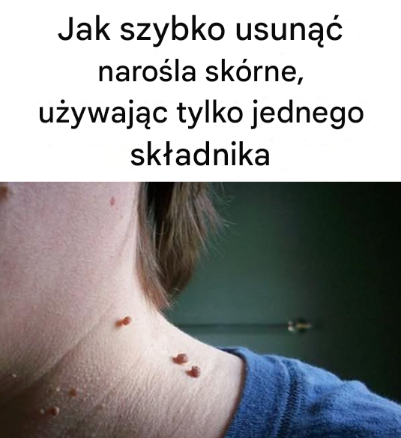Jak szybko usunąć narośla skórne, używając tylko jednego składnika