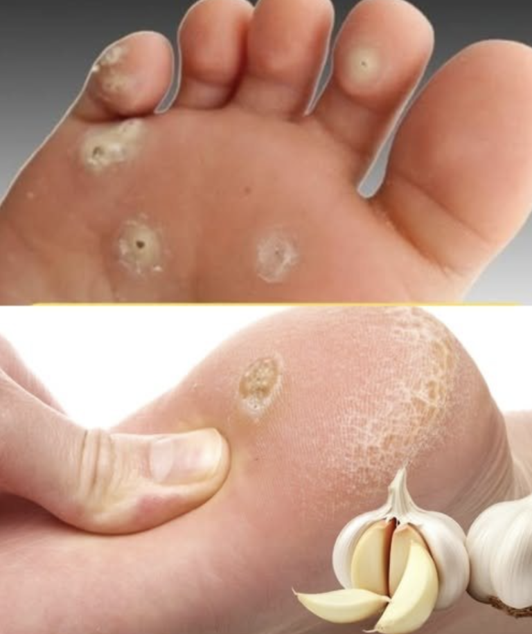 Wyeliminuj brodawki podeszwowe dzięki tym naturalnym środkom na bazie czosnku