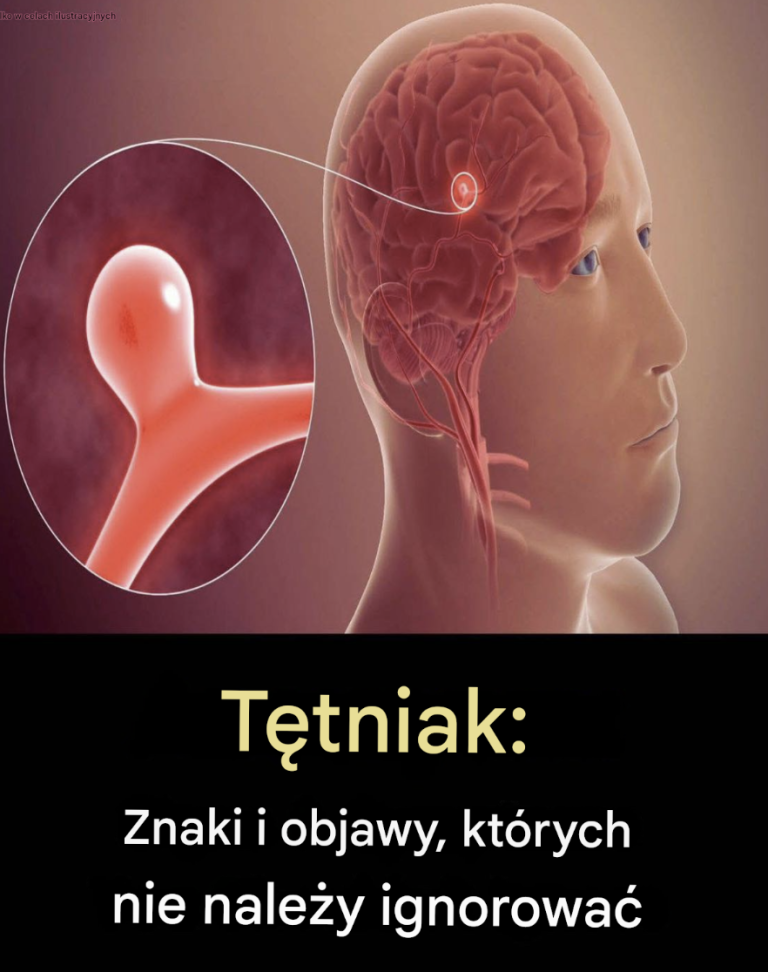Tętniak: objawy, których nie należy ignorować