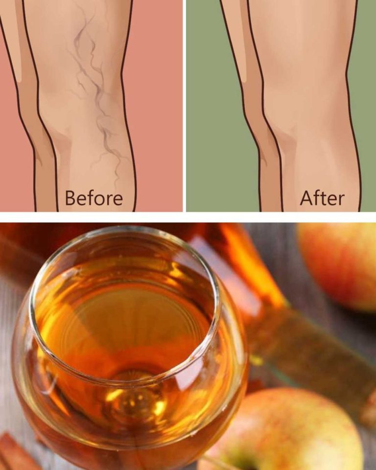 Nana przekazała te przepisy na pozbycie się żylaków